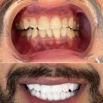 Application du gel blanchissant