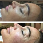 Prestation Microneedling BBGLOW