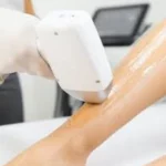 épilation laser diode